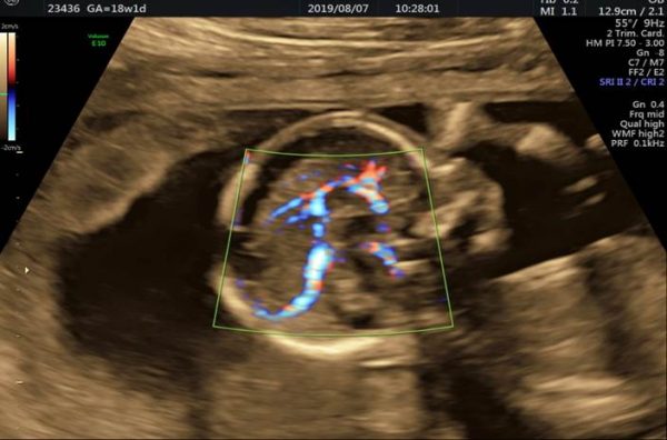 سونوگرافی جامع سه ماهه دوم بارداری (آنومالی اسکن)